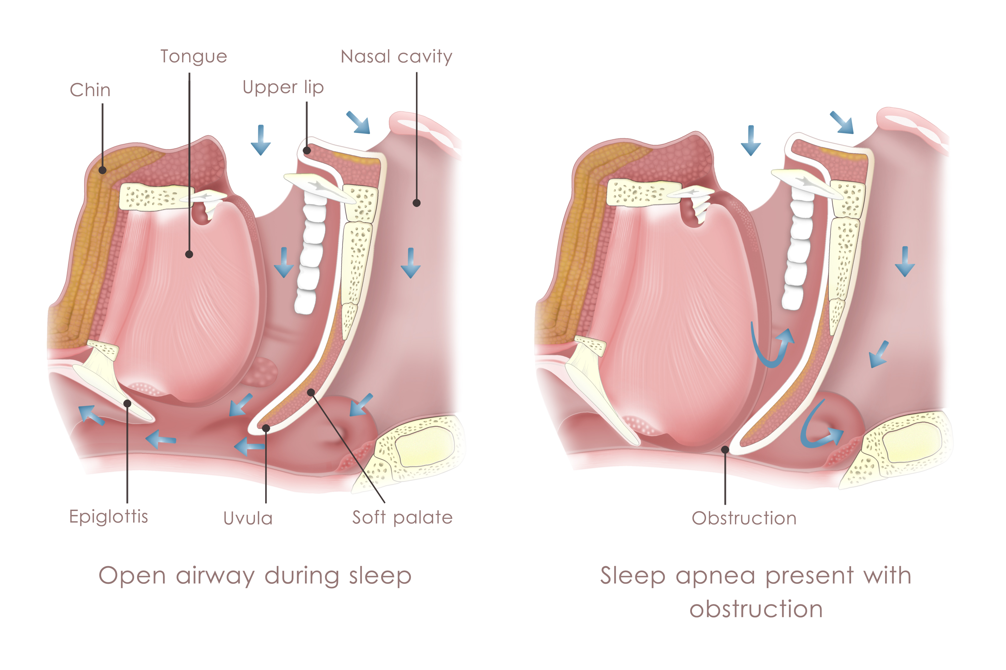 Open Airway vs Sleep Apnea Obstruction - Bethel, CT & Danbury, CT